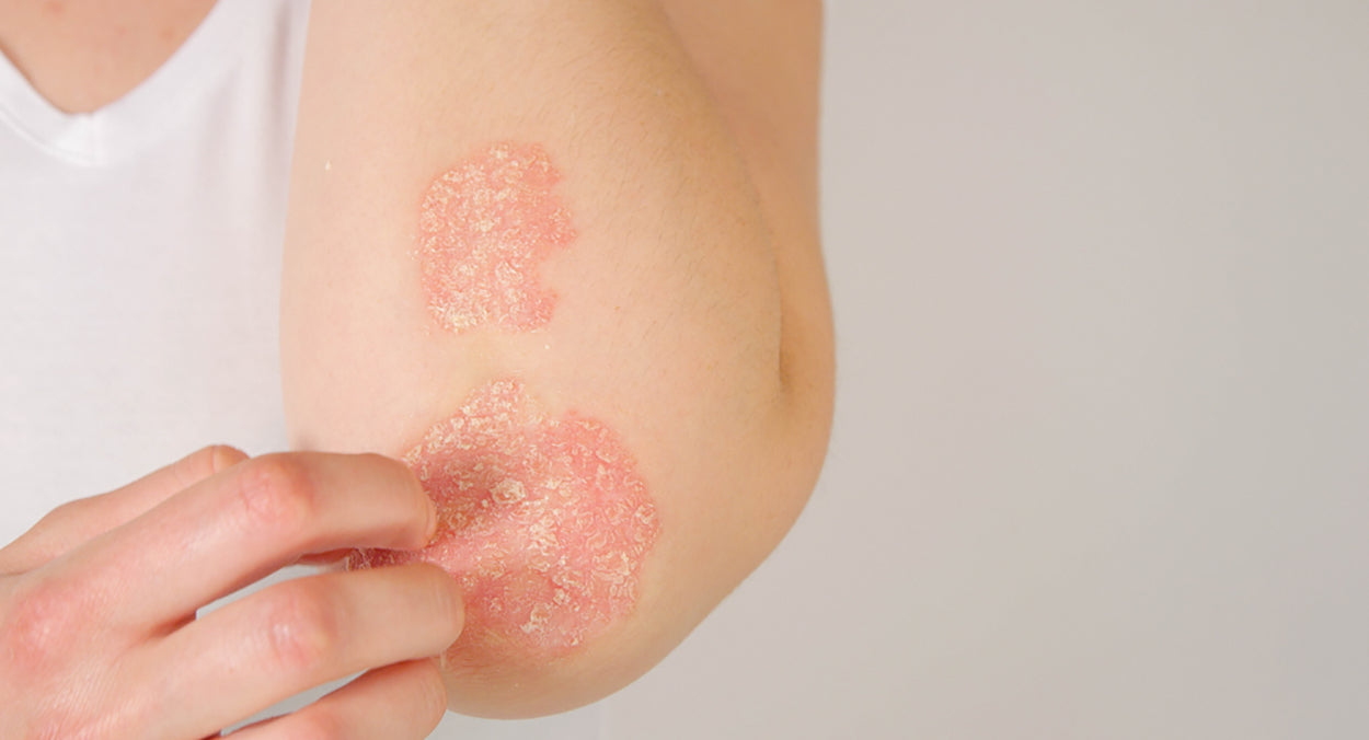 Psoriasis - A Naturopathic Approach