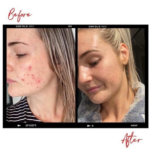 Images of a woman's face with ACNE before and after using Clémence Organics skin care products. In the after image the severity of the woman's ACNE has decreased significantly.