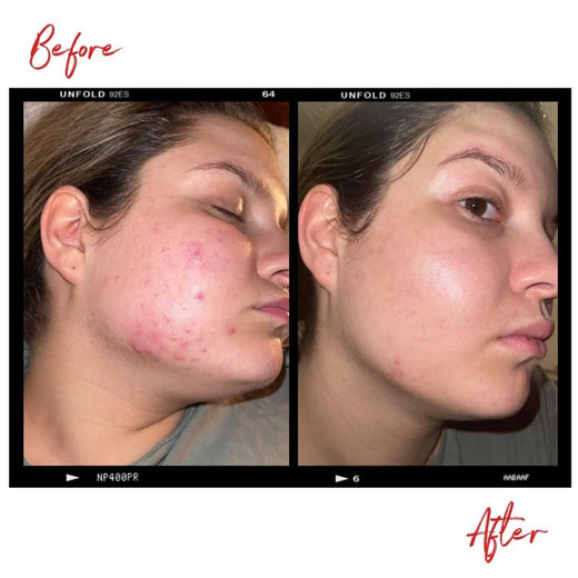 Images of a woman's face before and after using Clémence Organics skin care products. In the after image the quality of the woman's skin has increased significantly.