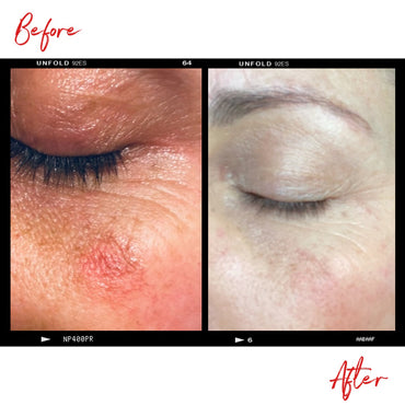 Images of a woman's eyes with sun spot and pigmentation before and after using Clémence Organics Repair Face Serum. In the after image the quality of the skin around the woman's eyes has increased significantly.