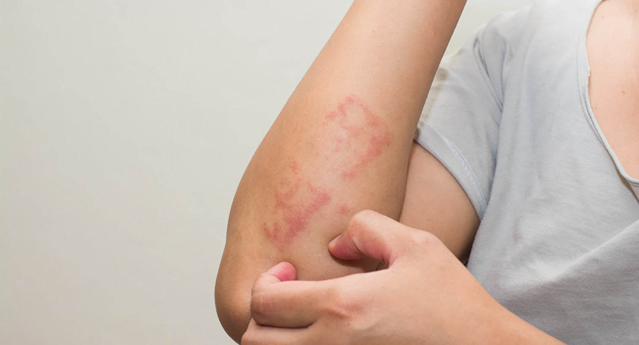 Eczema & Dermatits - a Naturopathic Approach