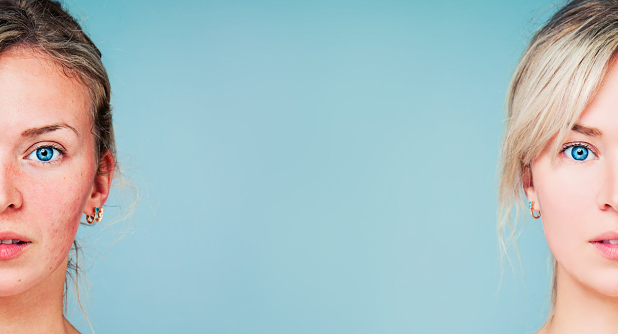 Clemence Organics Blog Natural Tips To Reduce Rosacea