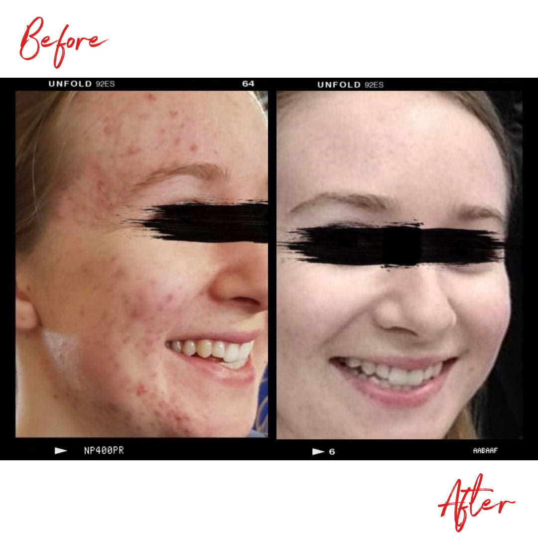 A woman's face before and after using organic skin care products. In the after image the quality of the woman's skin is much improved.