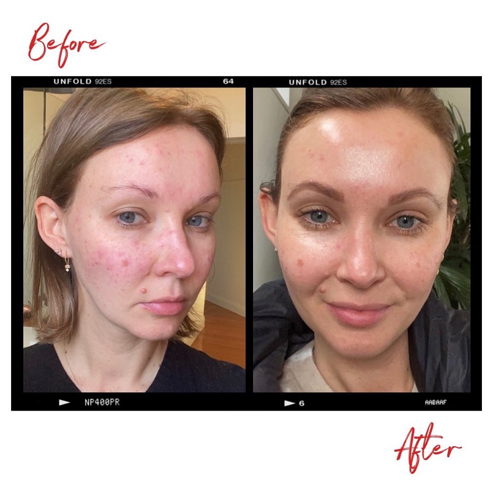 Images of a woman's face before and after using Clémence Organics skin care products. In the after images the quality of the woman's skin has greatly improved.