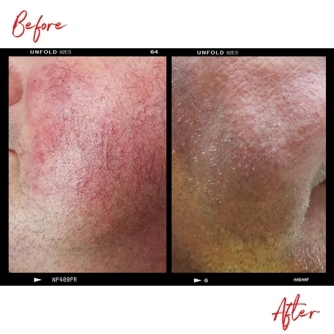 Images of a man's cheek with rosacea before and after using Clémence Organics skin care products. In the after image the severity of the rosacea has decreased significantly.