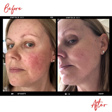 Images of a face before and after using Clémence Organics skin care products. In the after image the quality of the woman's skin has increased significantly.