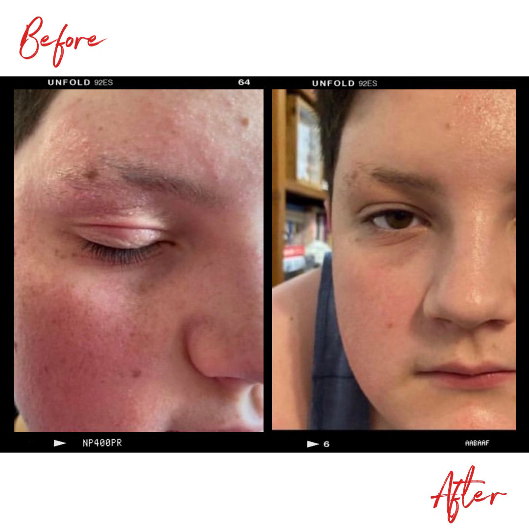 Images of a boys face with eczema before and after using Clémence Organics Ultimate SOS Balm. In the after image the severity of the eczema has decreased significantly.