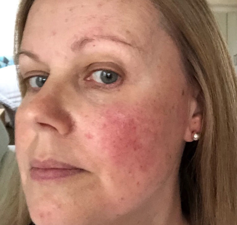 Cherith’s before photo, showing visible redness across her cheek and scattered facial blemishes.