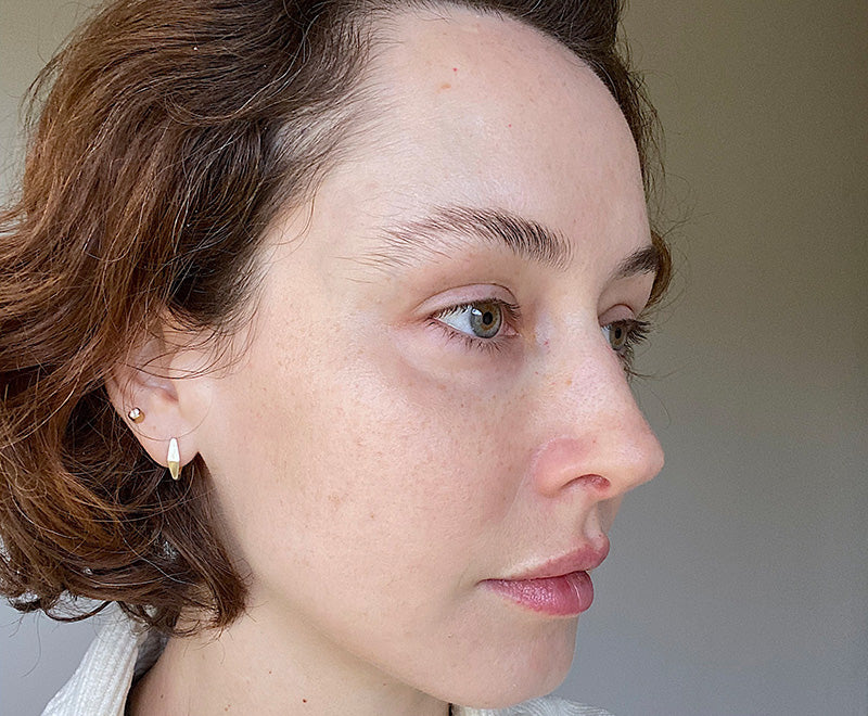 After photo showing a close side view of Isabella’s face, with an even looking complexion and slight redness around the nose.