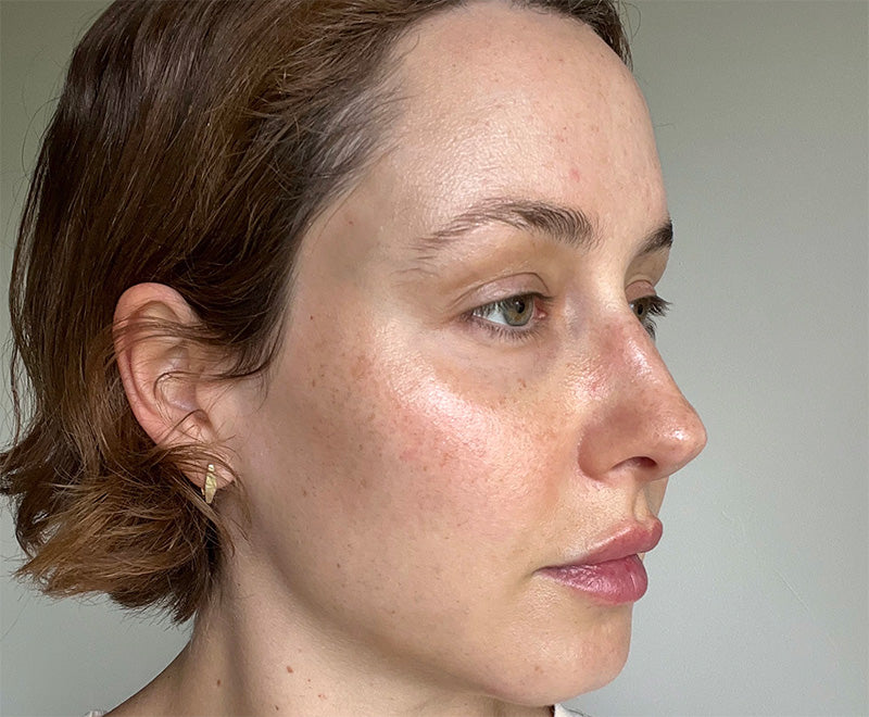 Before photo showing a close side view of Isabella’s face, with visible redness across the cheek and nose and small blemishes on the forehead.