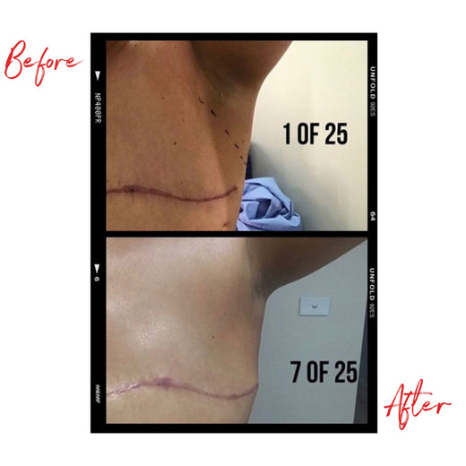 Images of a woman's post operative breast cancer scars before and after using Clémence Organics Ultimate SOS Balm. In the after image the scars have decreased significantly.