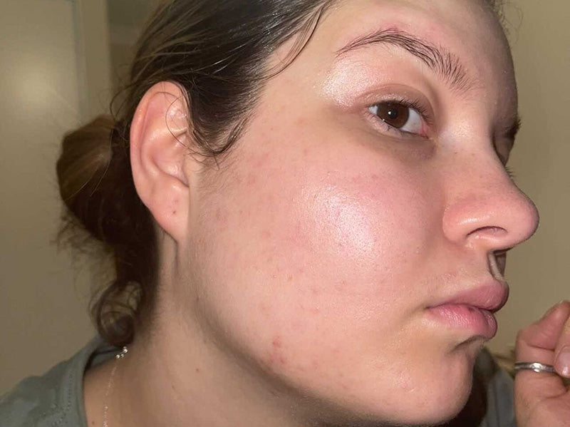 A close-up side profile of a woman's face showing her cheek and jawline.