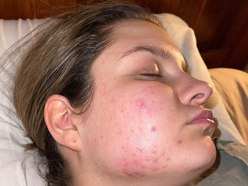 Close-up of a person lying down with closed eyes, showing facial acne and red blemishes on the cheek and jawline.