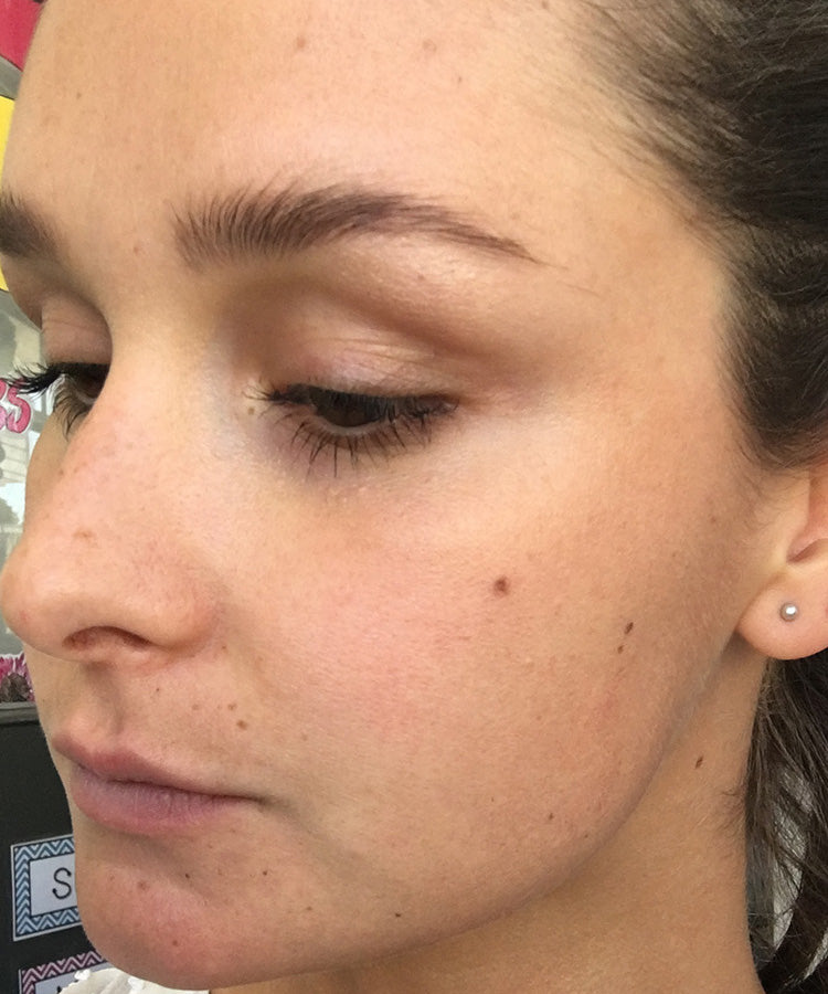 Ruby’s after photo, showing her cheek and forehead with a few small spots and visible freckles and moles.