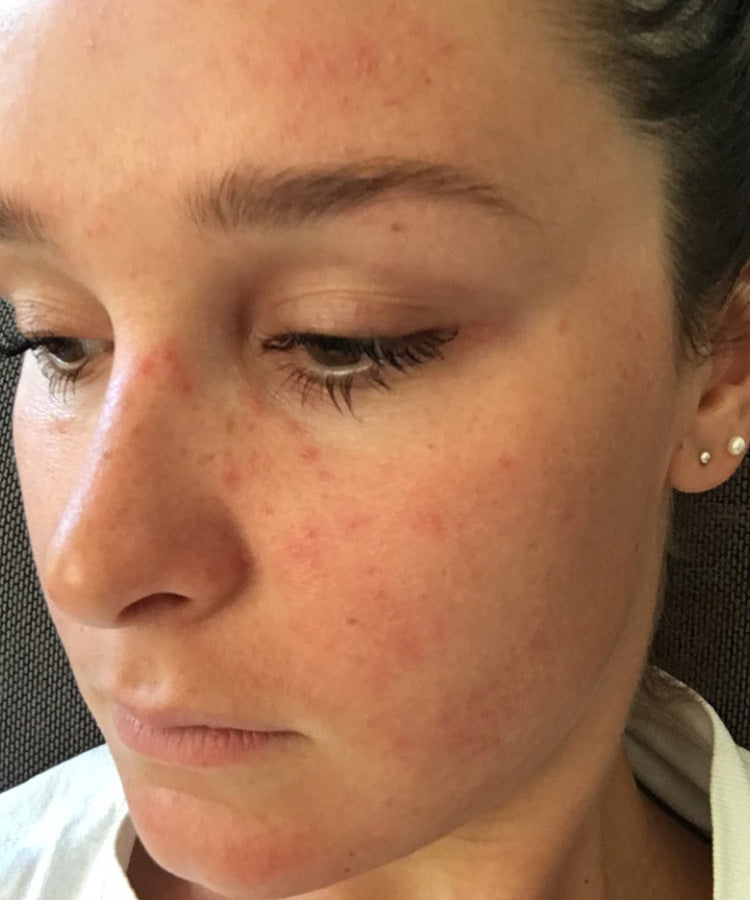 Ruby’s before photo, showing scattered red spots on her forehead, nose, cheek and chin.