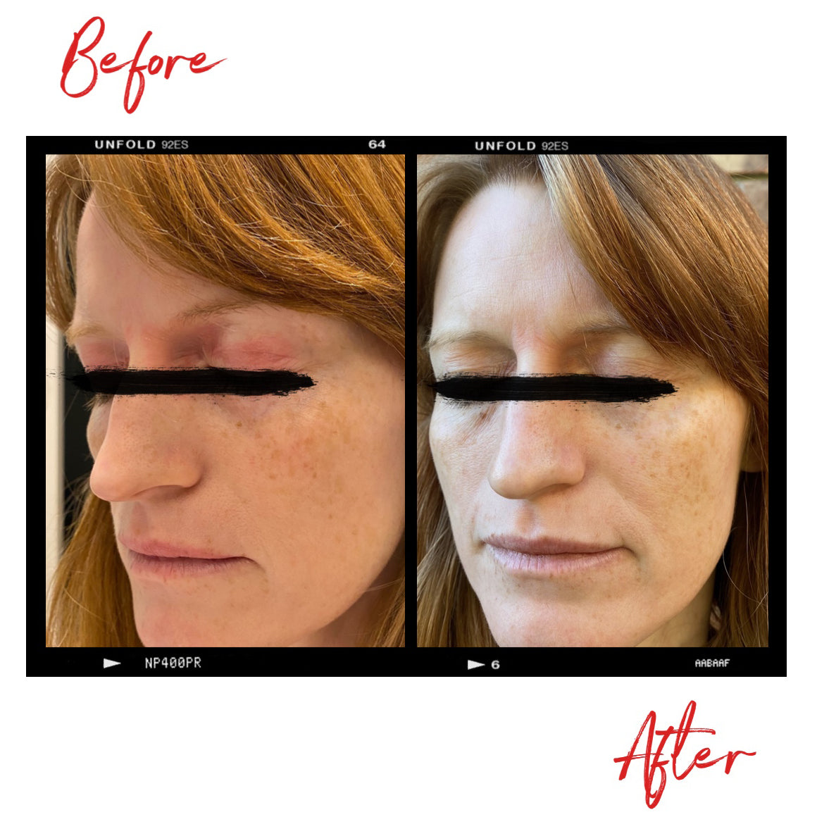 Images of a woman's face before A woman's face before and after using Clémence Organics Ultimate SOS Balm. In the after image the quality of the woman's skin is much improved.cs skin care products.